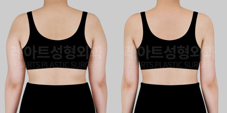 arm-liposuction-before-and-after-30802