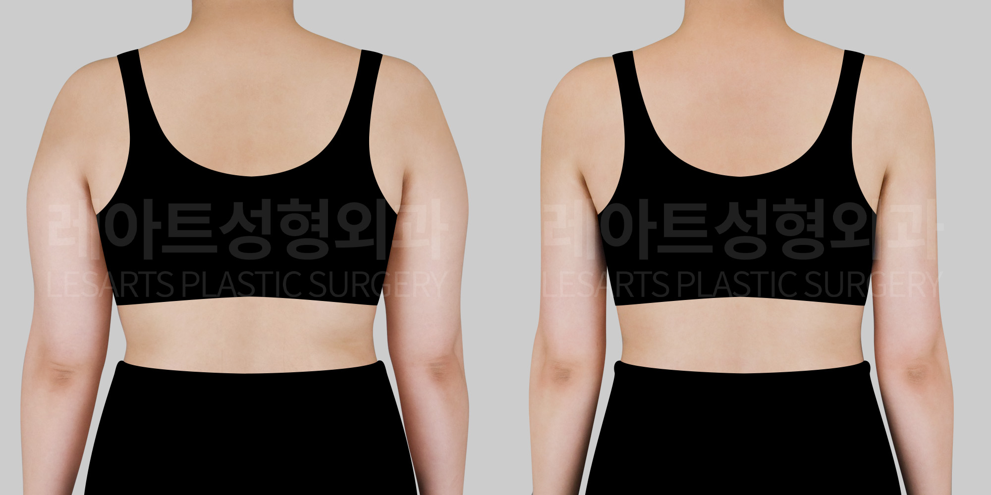 arm-liposuction-before-and-after-30802