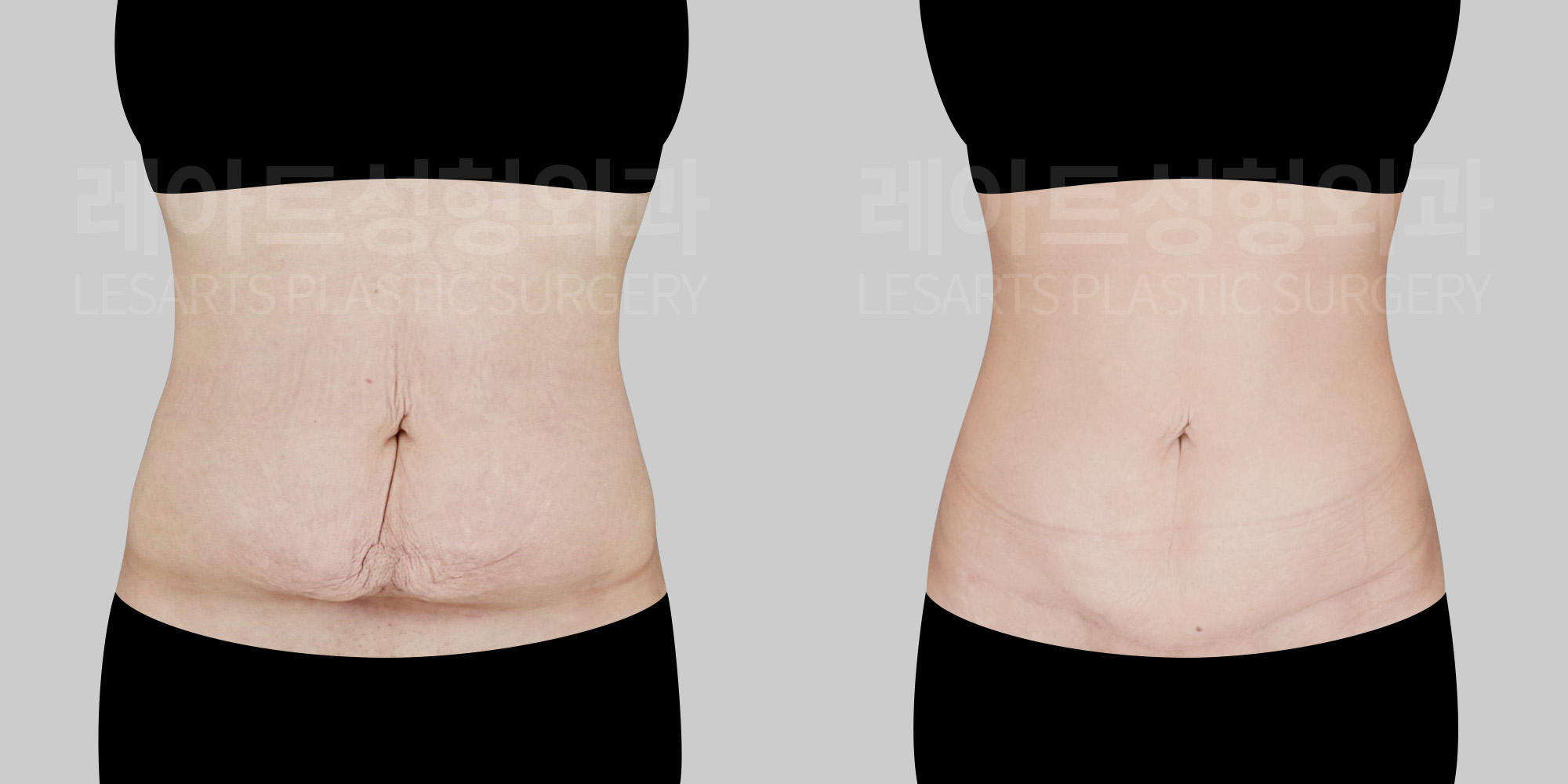 abdominoplasty-before-and-after