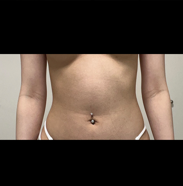 AmuNoraenayo arm and abdominal liposuction before photo in Korea – Lesarts Plastic Surgery