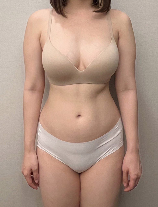 Ibyeongju thigh, arm liposuction before photo in Korea – Lesarts Plastic Surgery