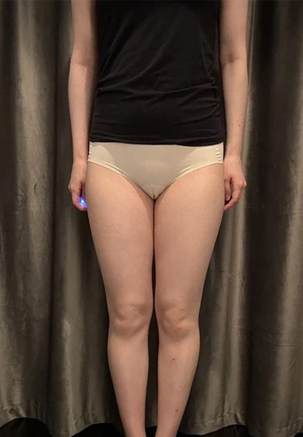 Kkojilkkojilnyang thigh liposuction before photo in Korea – Lesarts Plastic Surgery