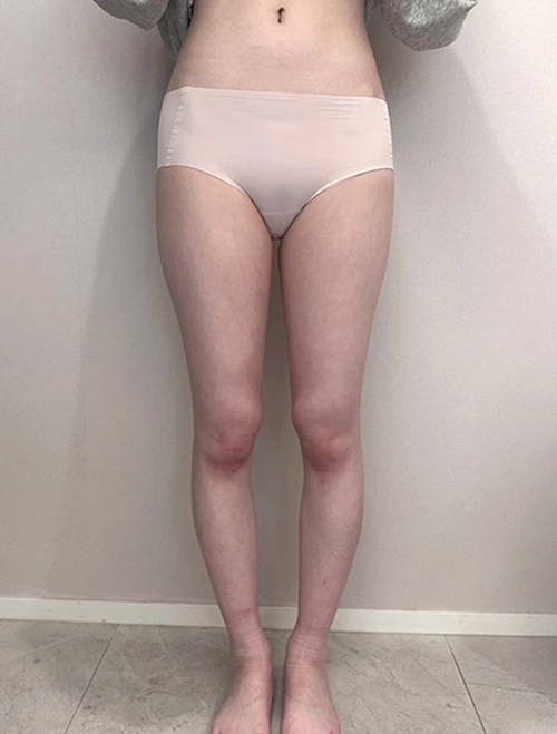 Patrasheubung thigh liposuction before photo in Korea – Lesarts Plastic Surgery