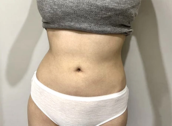 SesangEolleongttungttang thigh and abdominal liposuction before photo in Korea – Lesarts Plastic Surgery