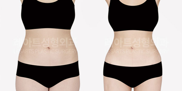 abdominal-liposuction-before-and-after-251010