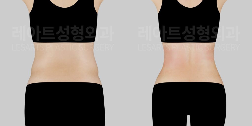 abdominal-liposuction-before-and-after-30000