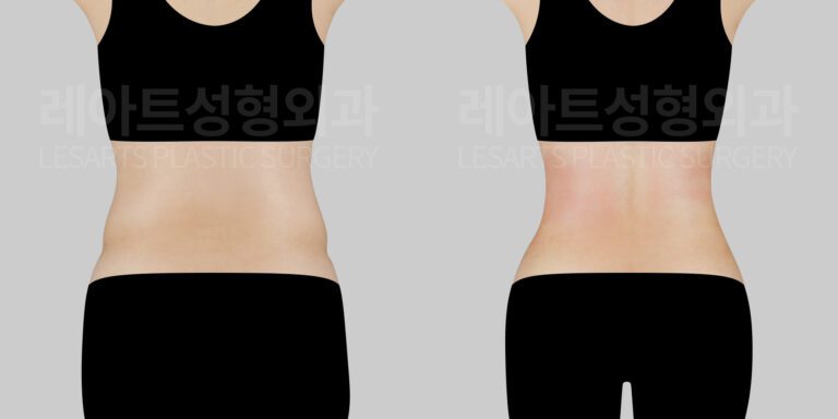 abdominal-liposuction-before-and-after-30000