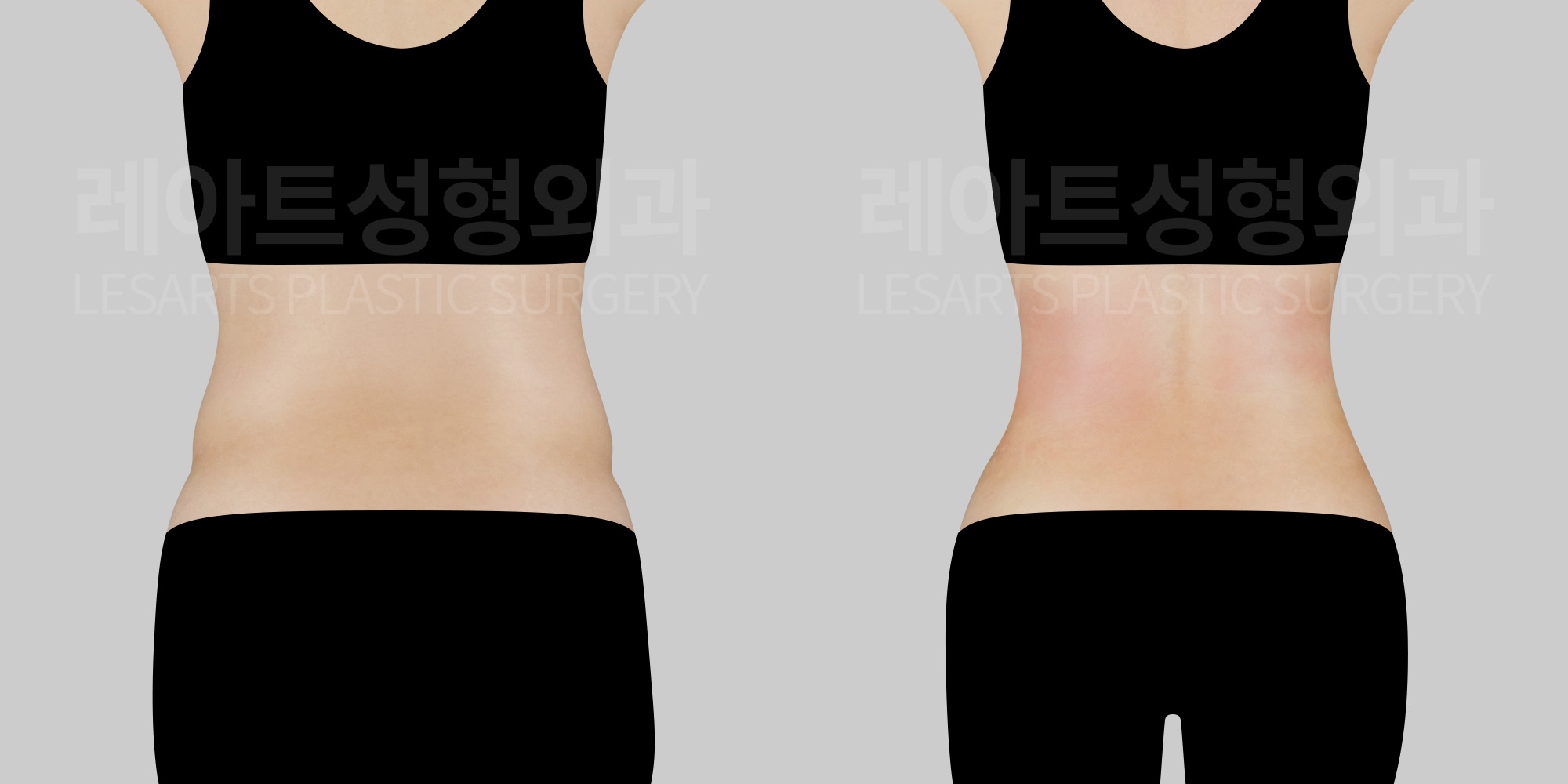 abdominal-liposuction-before-and-after-30000