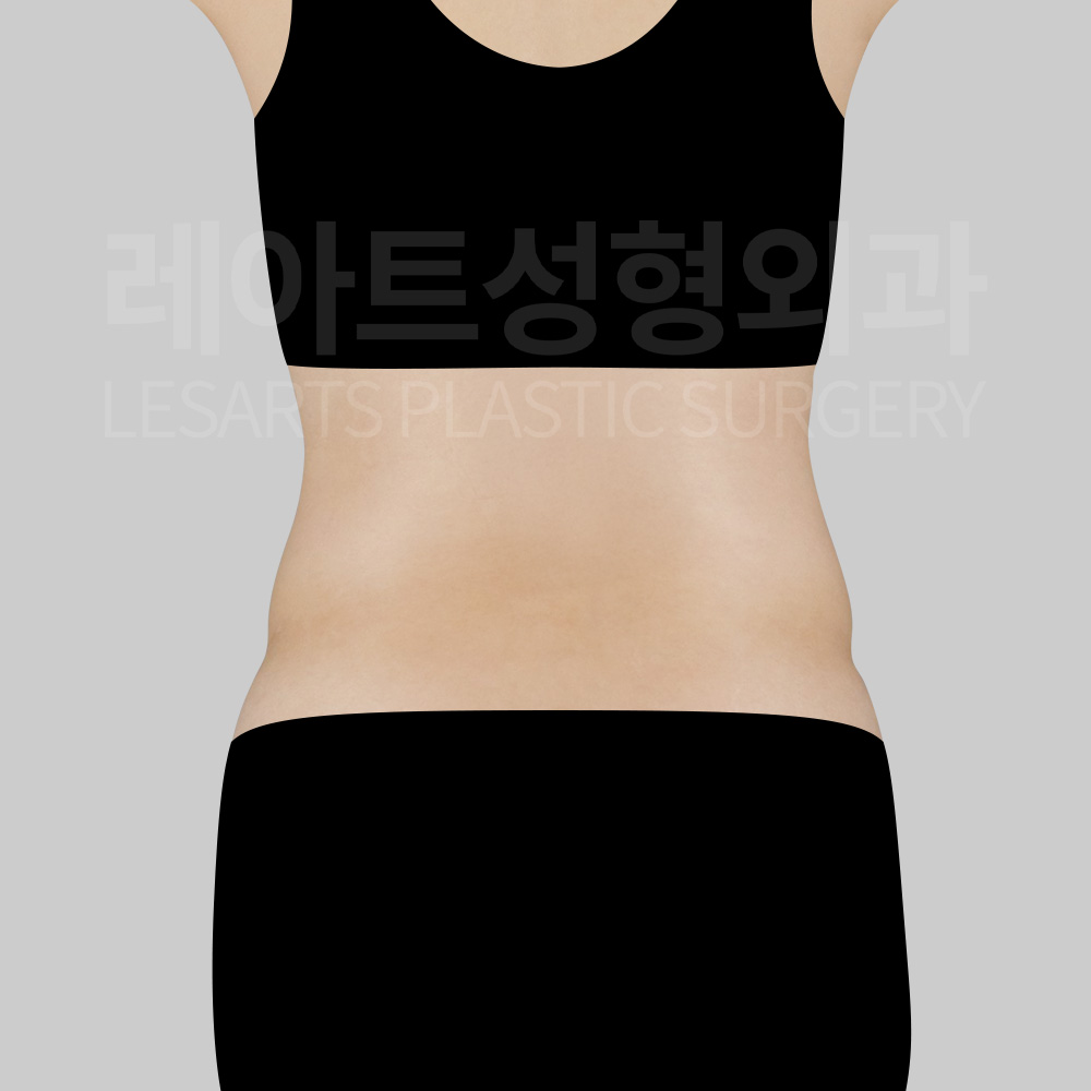 abdominal-liposuction-30000-before-back