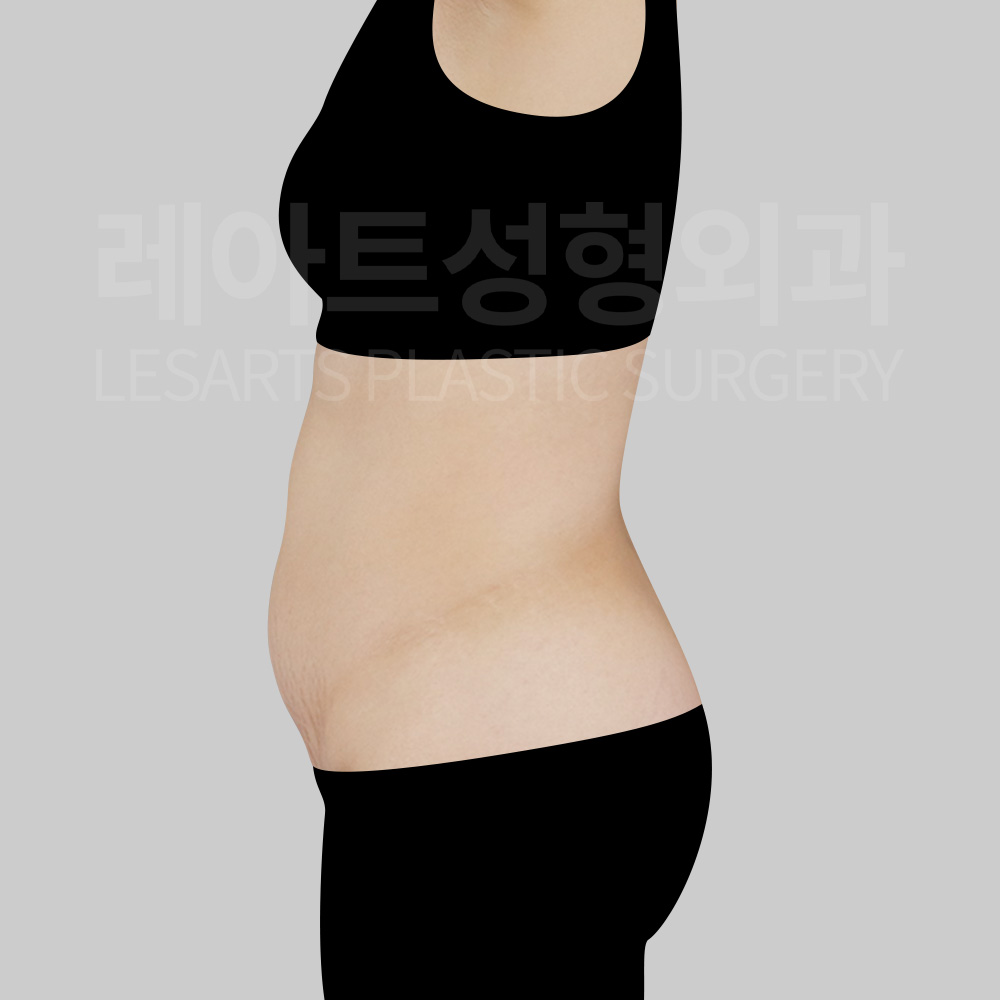 abdominal-liposuction-30000-before-side
