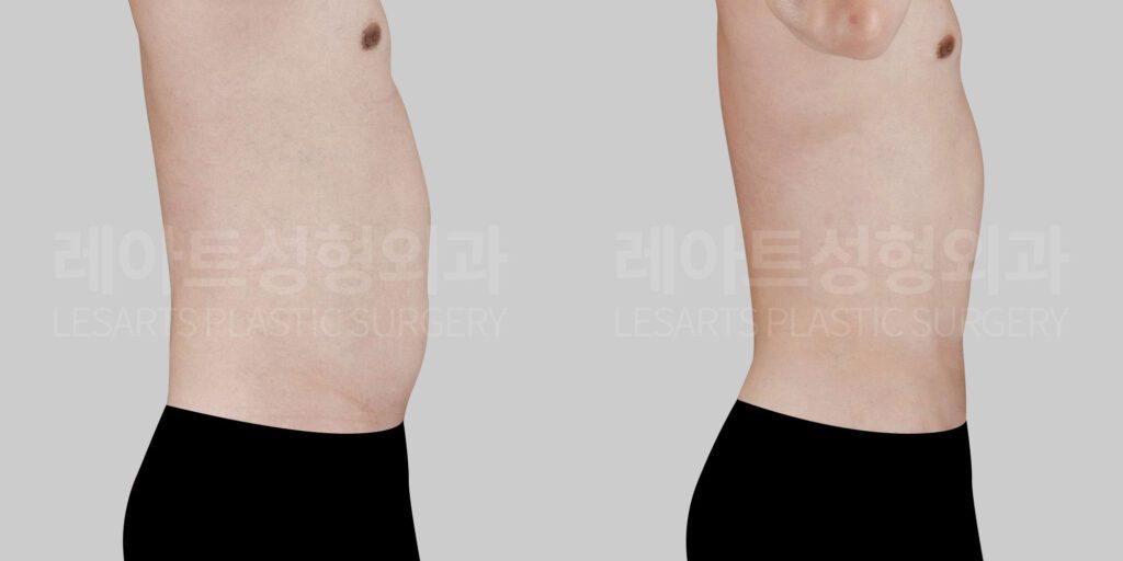 male-abdominal-liposuction-30112-before-and-after-front