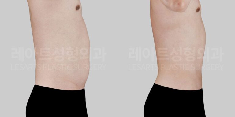 male-abdominal-liposuction-30112-before-and-after-front