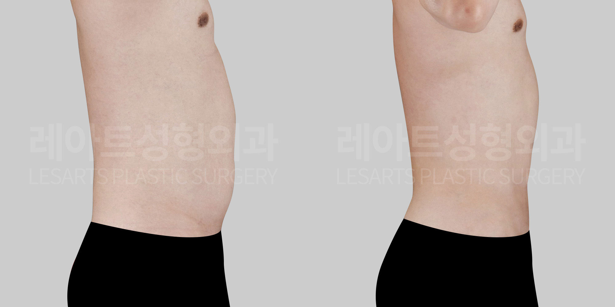 male-abdominal-liposuction-30112-before-and-after-front