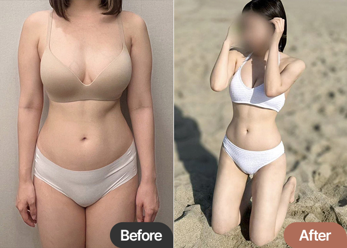 Ibyeongju arm thigh liposuction before and after comparison – Best Liposuction Clinic in Korea Lesarts