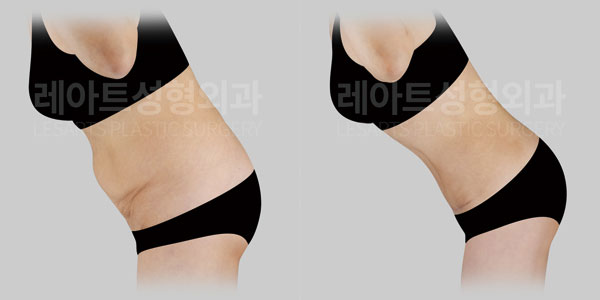abdominoplasty-before-and-after-251014