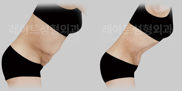 abdominoplasty before and after-Lesarts Plastic Surgery-251015