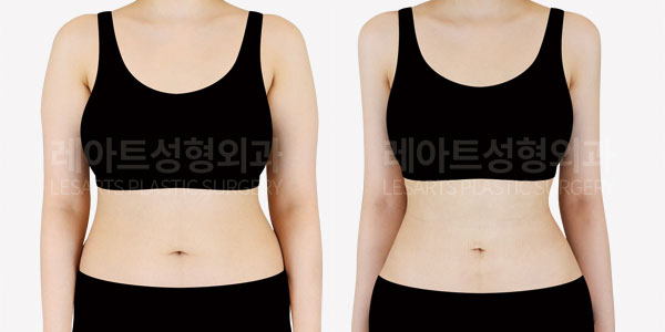 arm-liposuction-01-thumbnail-251014