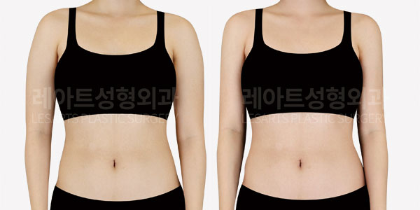 arm-liposuction-before-and-after-251015