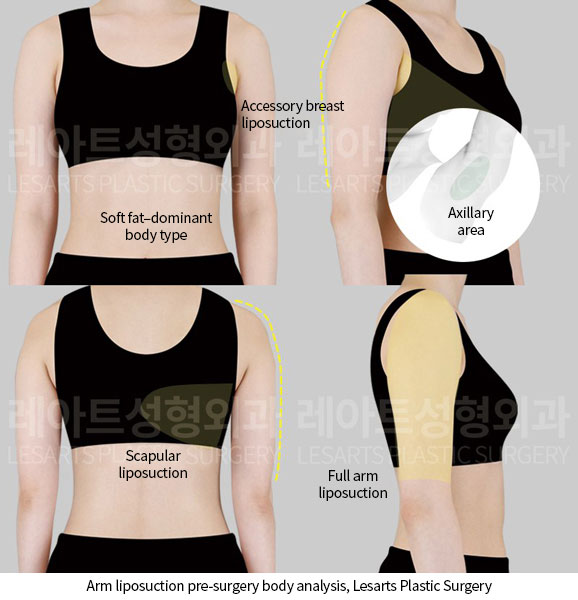 arm-liposuction-02-01-251005