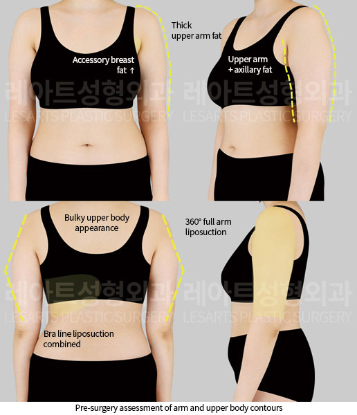 arm-liposuction-01-thumbnail-251014