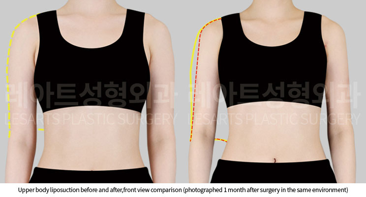 arm-liposuction-02-02-251005