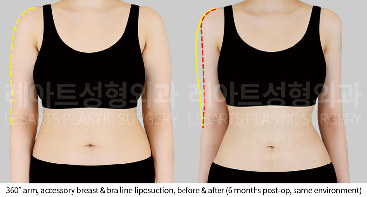 arm-liposuction-02-02-251014