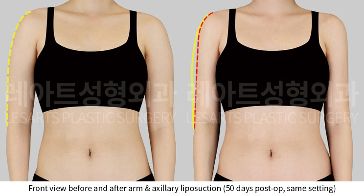 arm-liposuction-02-02-251015