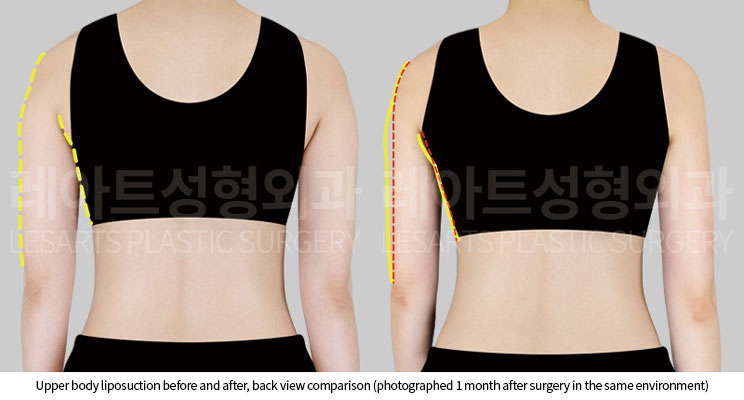 arm-liposuction-02-03-251005