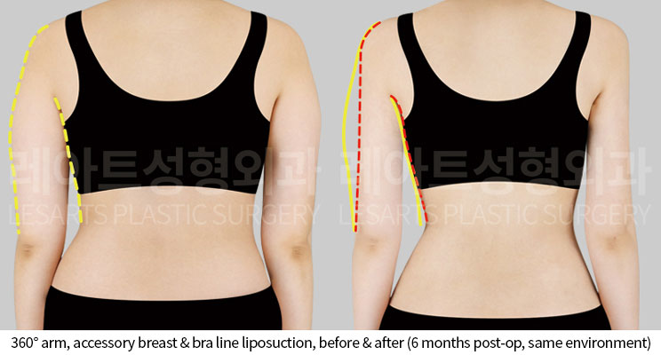 arm-liposuction-02-03-251014