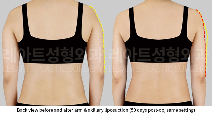 arm-liposuction-02-03-251015