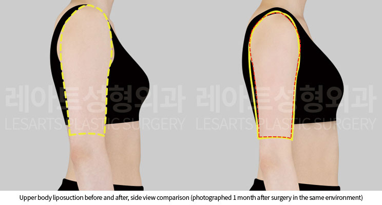 arm-liposuction-02-04-251005