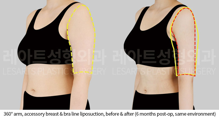 arm-liposuction-02-04-251014