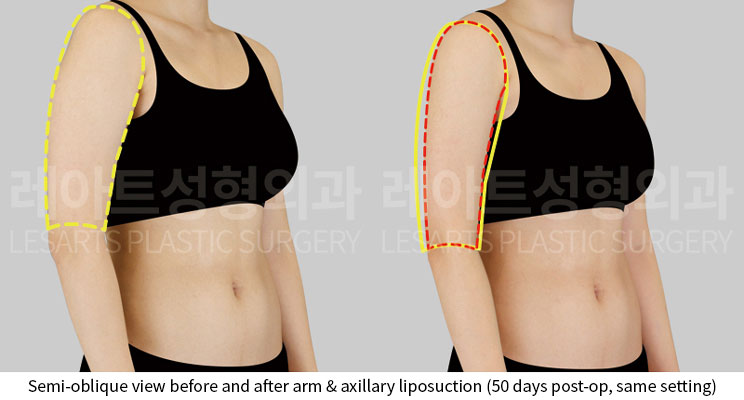 arm-liposuction-02-05-251015