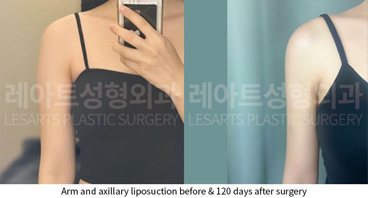 arm-liposuction-02-06-251015
