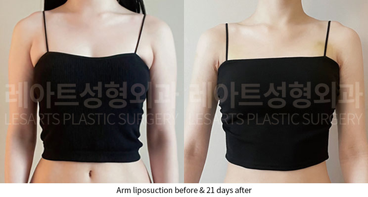 arm-liposuction-02-07-251005