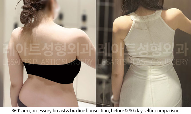 arm-liposuction-02-07-251014
