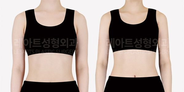 arm-liposuction-before-and-after-01-thumbnail-251005