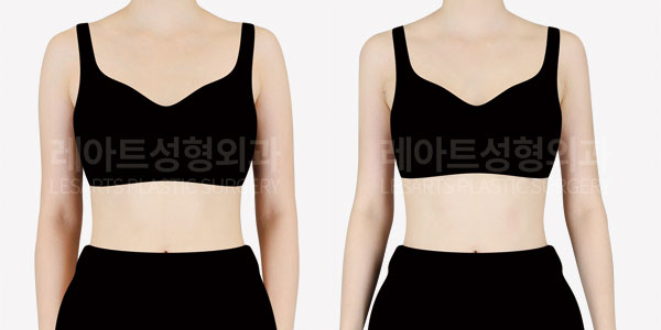 arm_liposuction_01_thumbnail_251002