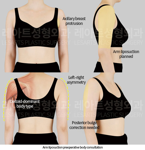 arm_liposuction_02_01_251002