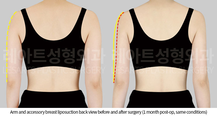 arm_liposuction_02_03_251002