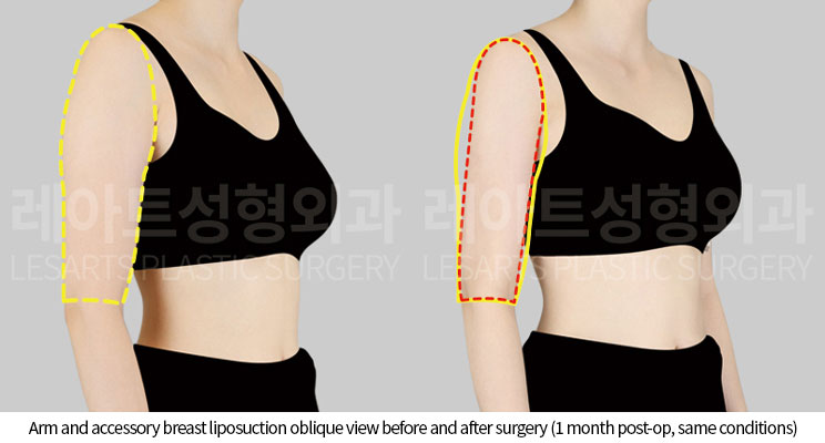 arm_liposuction_02_04_251002