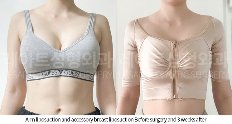 arm_liposuction_02_05_251002