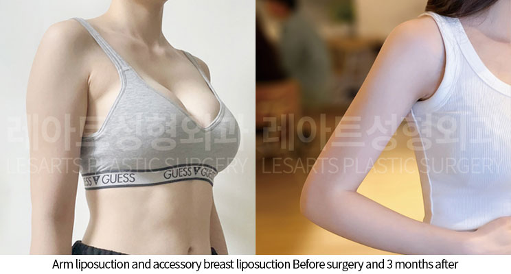 arm_liposuction_02_06_251002