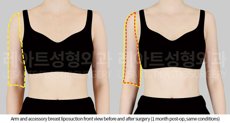 arm_liposuction_02_02_251002_before_and_after