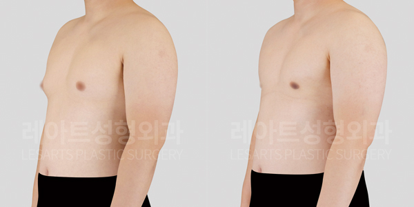 gynecomastia-before-and-after-251005