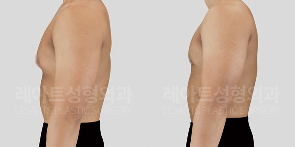 gynecomastia-before-and-after-thumbnail-251014