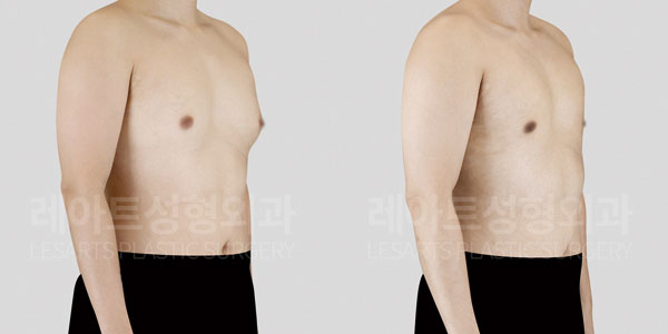 gynecomastia-before-and-after-251012