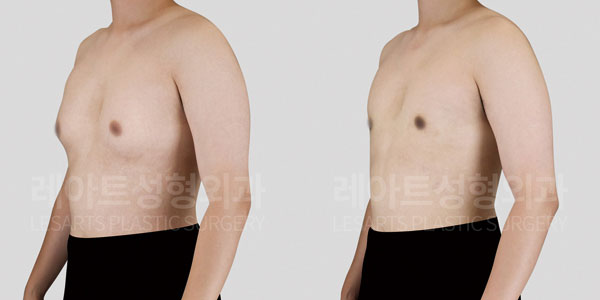 gynecomastia-before-and-after-251015