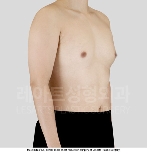 gynecomastia-02-01-251015