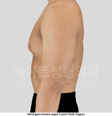 gynecomastia-02-02-251014